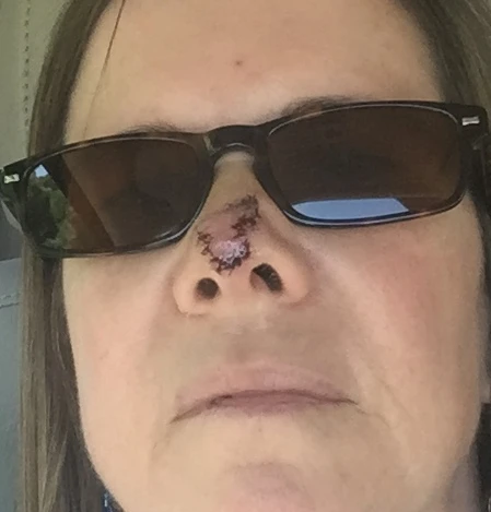 nose1